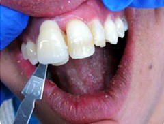 Porcelain Bonded Crowns