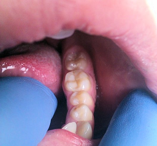 Composite Inlays and Onlays Manchester, Cheshire and Lancashire