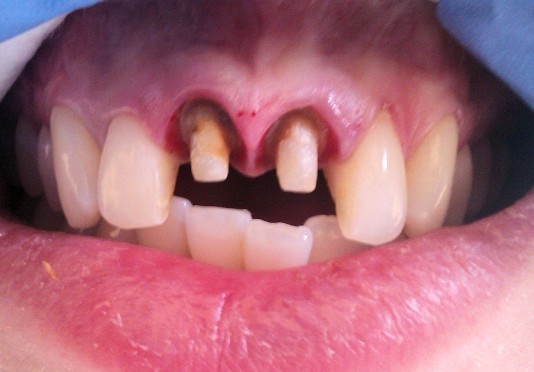 Teeth reshaped and prepared